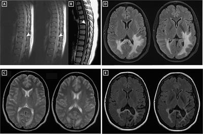 Acute Myelitis, Recurrent Optic Neuritis, and Seizures Over 17 Years